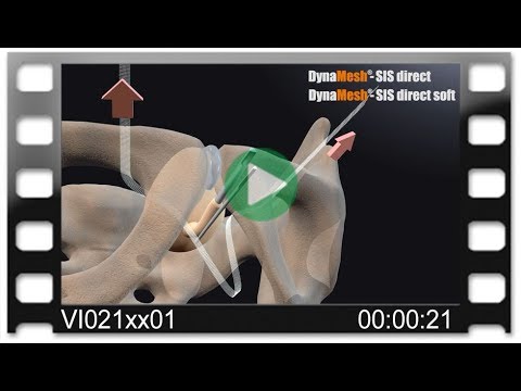 DynaMesh®-SIS direct - Animation: SUI Treatment - Transobturator (out/in) - TOT 8/4