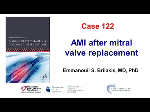 Case 122: PCI Manual - AMI after mitral valve replacement
