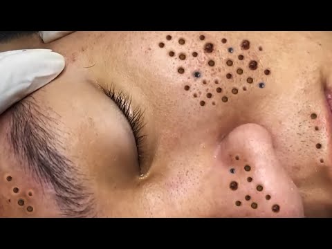 Blackhead removal Video #46 #Blackheads #blackheadsremoval #sebum