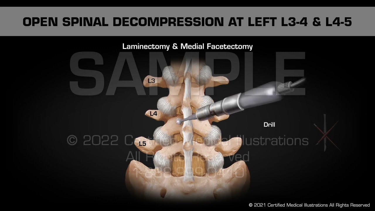 Open Spinal Decompression at Left L3-4 & L4-5