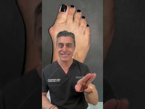 What are the best non-surgical treatments for bunions?