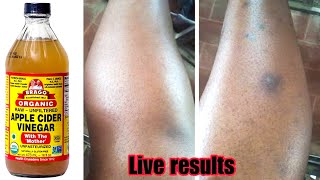HOW TO: REMOVE DARK SPOTS FROM YOUR LEGS IN 3DAYS,100% WORKING