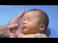 Jaundice Examination Of The Newborn