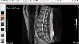 preview picture of video 'Bozeman Chiropractor Hans Conser Shows Lumbar Disc Herniation on MRI'