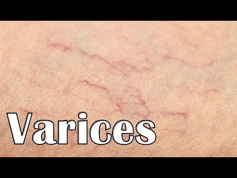 curar las arañas vasculares naturalmente