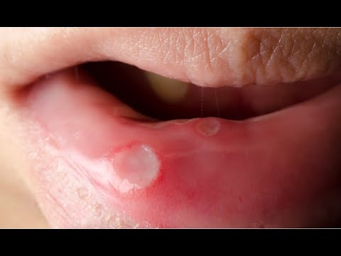 Canker Sores