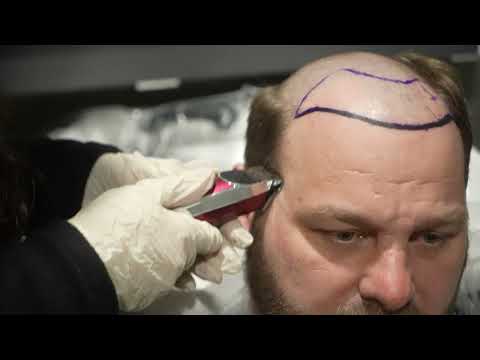 Hair Transplant Turkey