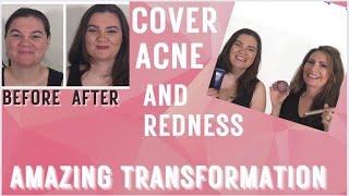AMAZING Transformation | Completely cover REDNESS and ACNE without clogging pores | Product Review
