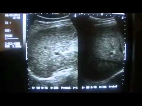 Prostatamassage Adler Biene Podmore bei der Behandlung von Prostata