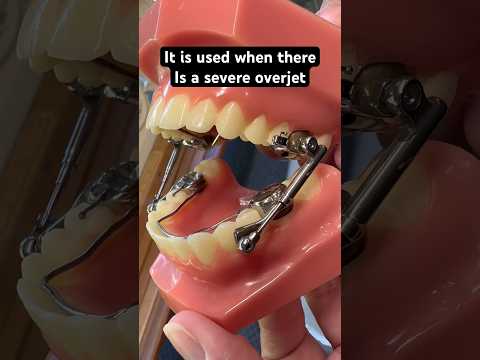 What happened?   Herbst Appliance for cases of severe overjet  #teeth #braces #orthodontics #bentist