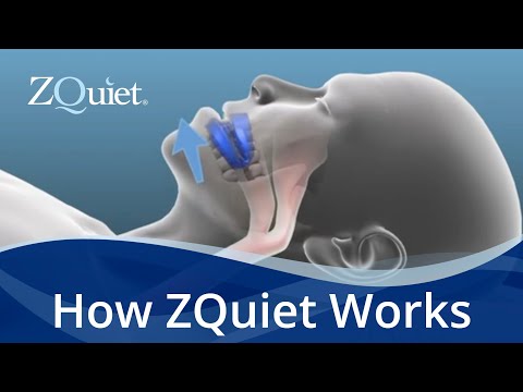 Want to Stop Snoring? Learn How ZQuiet Anti Snoring Mouthpieces Work
