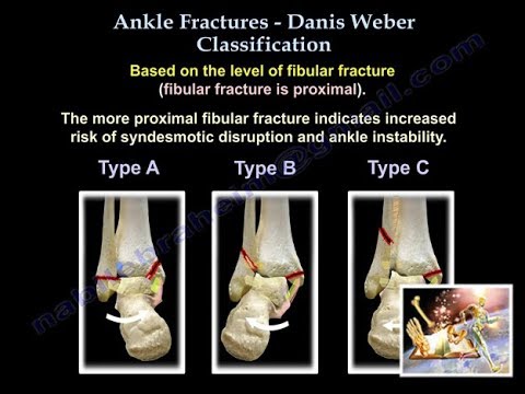 Ankle Fractures Danis Weber Classification - Everything You Need To Know - Dr. Nabil Ebraheim