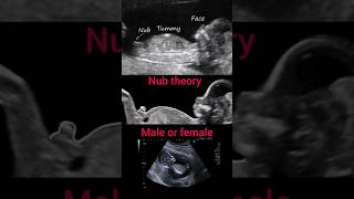 Download lagu Nub theory||male or female||pregnancy #ultrasound#baby#shorts mp3