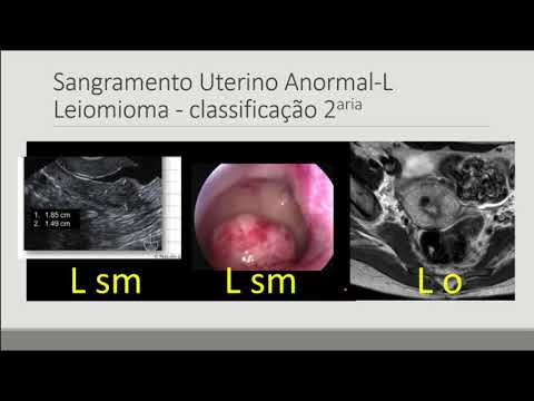 Papel dos métodos de imagem no sangramento uterino anormal