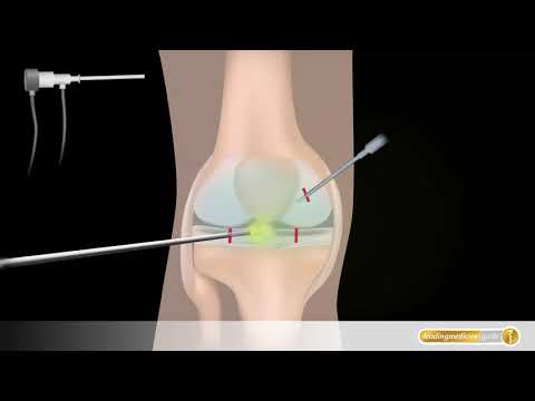 Die Behandlung des Vorsprungs des Lenden nationalen Weges Schmerzen im Nacken und Kopf mit Osteochondrose Skoliose