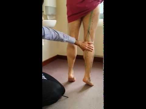 5. LL Sacral Plexus - Tibial nerve