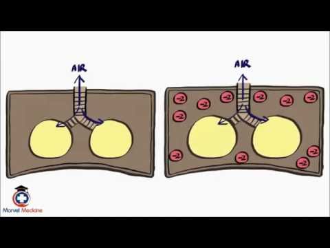 Pneumothorax and Tension Pneumothorax