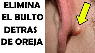 Todo Lo Que Necesitas Saber Sobre Ese BULTO Detrás De La Oreja