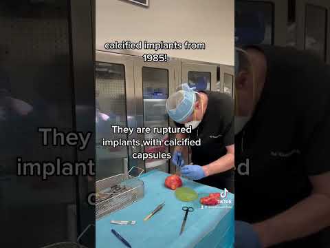 Is It Safe to Remove 40-Year-Old Breast Implants with the Entire Capsule?