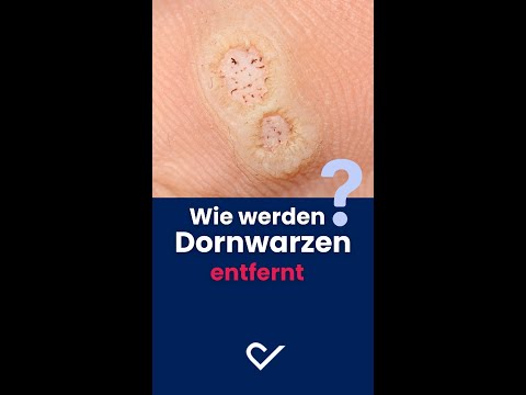 Warzen entfernen l DERMAFY #shorts