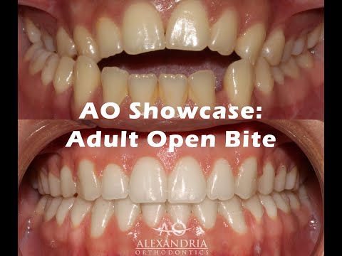 Alexandria Orthodontics Showcase: Adult Open Bite