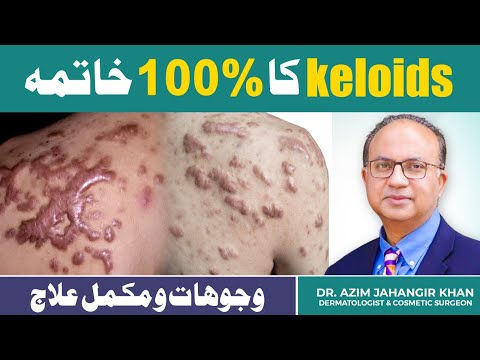 Keloid Removal Without Surgery | Safe & Effective Keloid Treatments | Cosmetique