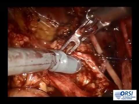 Robotic Assisted Radical Cystectomy in the Female