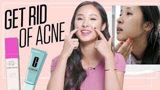How to Remove Pimples Fast and Get Clear Skin | Acne Tips