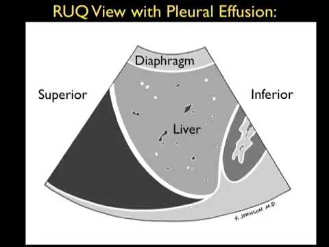 How to check pleural fluid on ultrasound|sonology