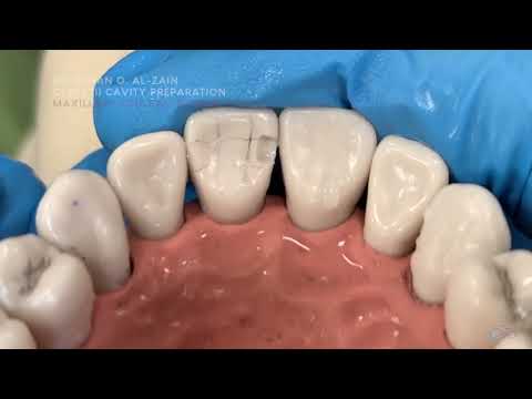 Class III cavity preparation – Maxillary central incisor (#11) moderate to large cavity- Arabic عربي