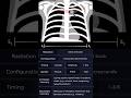 Pulmonary Flow Murmur Part 2