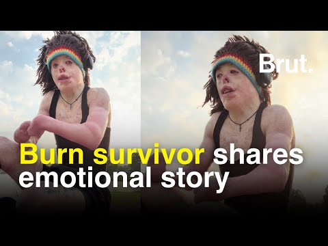 Burn survivor, Johnny Quinn, shares emotional story