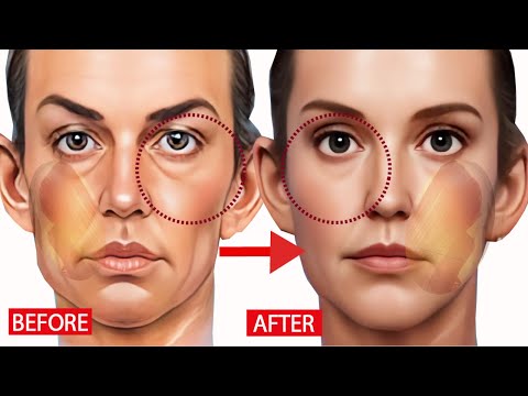 15 mins!🔥 Fix Middle Cheek Lines, Eye Bags, Tear Troughs. Anti-Aging Exercise to look younger!