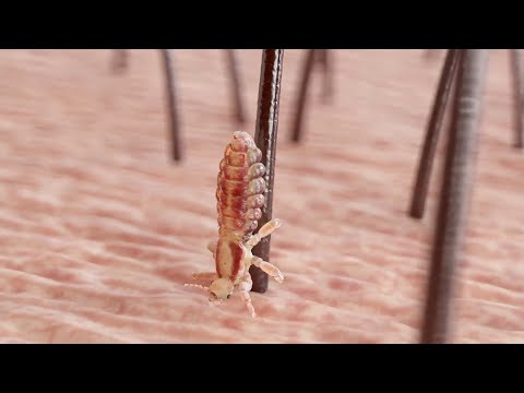 Nyda – About Head Lice with Pharmacist Sherry Torkos – Educational Video (16:9, EN, CAN)