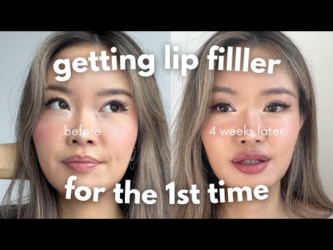 first time getting lip filler??!? | 4 week healing process vlog