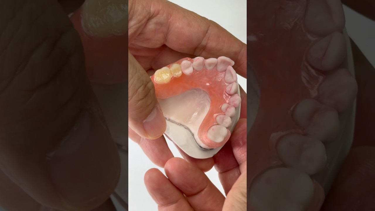 FiberFlex partial for Dr. Michael Connally in Indiana