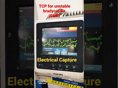Transcutaneous Pacing for unstable bradycardia(CHB) patient. #emergencymedicine. #manipalhospitals