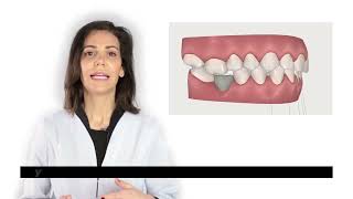 PLAN DE TRATAMIENTO VIRTUAL 3D DE ORTODONCIA - TÉCNICA INVISALIGN - Clínica Cristina Viyuela