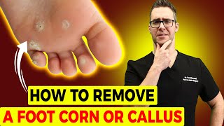 How to REMOVE Thick Dry Skin, Calluses & Corns [HOME Remedies]