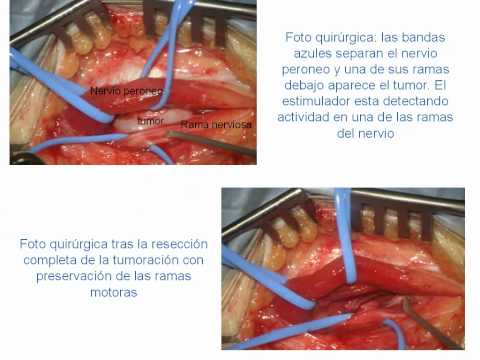 Neurinoma de Nervio Periférico