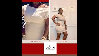 My Lipo 360 Journey|Dr. Cliff Cannon|Vixen Plastic Surgery