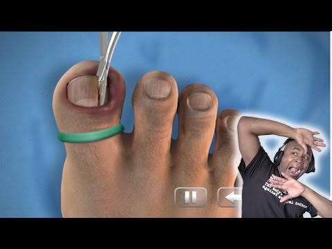 Halamang-singaw sa pagitan ng toes ng paa ulser Kuko halamang-singaw medikal na paggamot