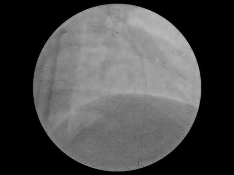 CTO IN YOUNG (38 YRS) - ANTEGRADE WIRE ESCALATION