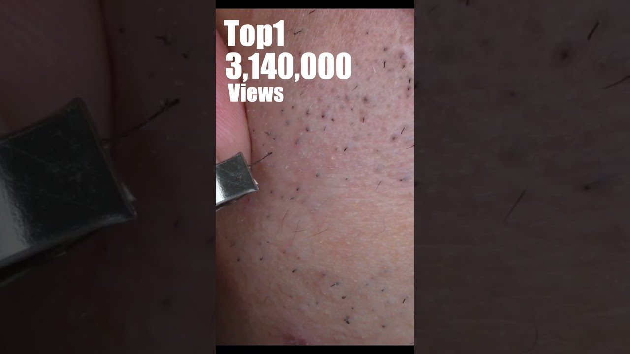 Top 5 video views in 2024 #shots  #tweezers  #毛抜き
