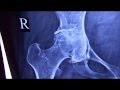 Avascular Necrosis of Head of Femur - Pain hip joint
