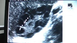 Ultrassom de ovarios policisticos