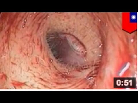 comment soulager un tympan percé