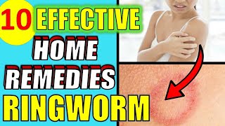 10 Effective Home Remedies For Ringworm (NATURAL HOME TREATMENTS)