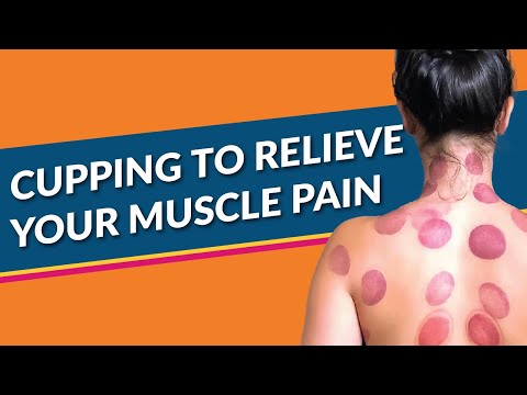What you need to know about Cupping Therapy - from a Dr. of Acupuncture and Chinese Medicine