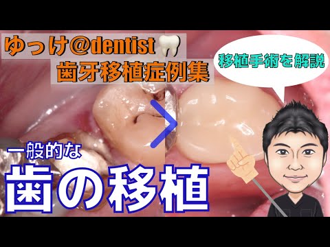 生命歯学科 【治療症例集】歯を抜歯しなければならなくなった方必見！インプラント、ブリッジ、入れ歯に次ぐ第4の治療法「歯の移植」をわかりやすく解説！抜歯宣告された歯を抜いてしまうその前にぜひご覧ください！